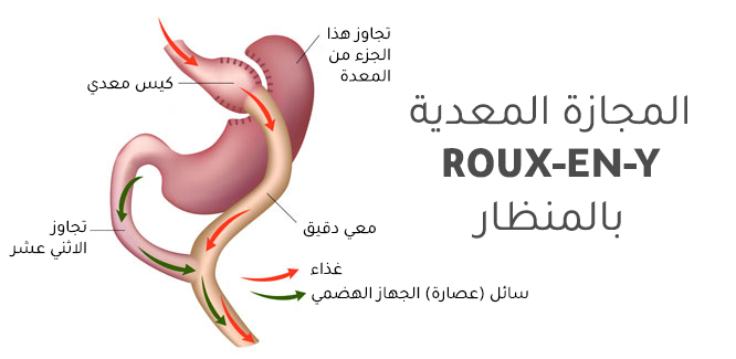 المجازة المعدية ROUX-EN-Y بالمنظار