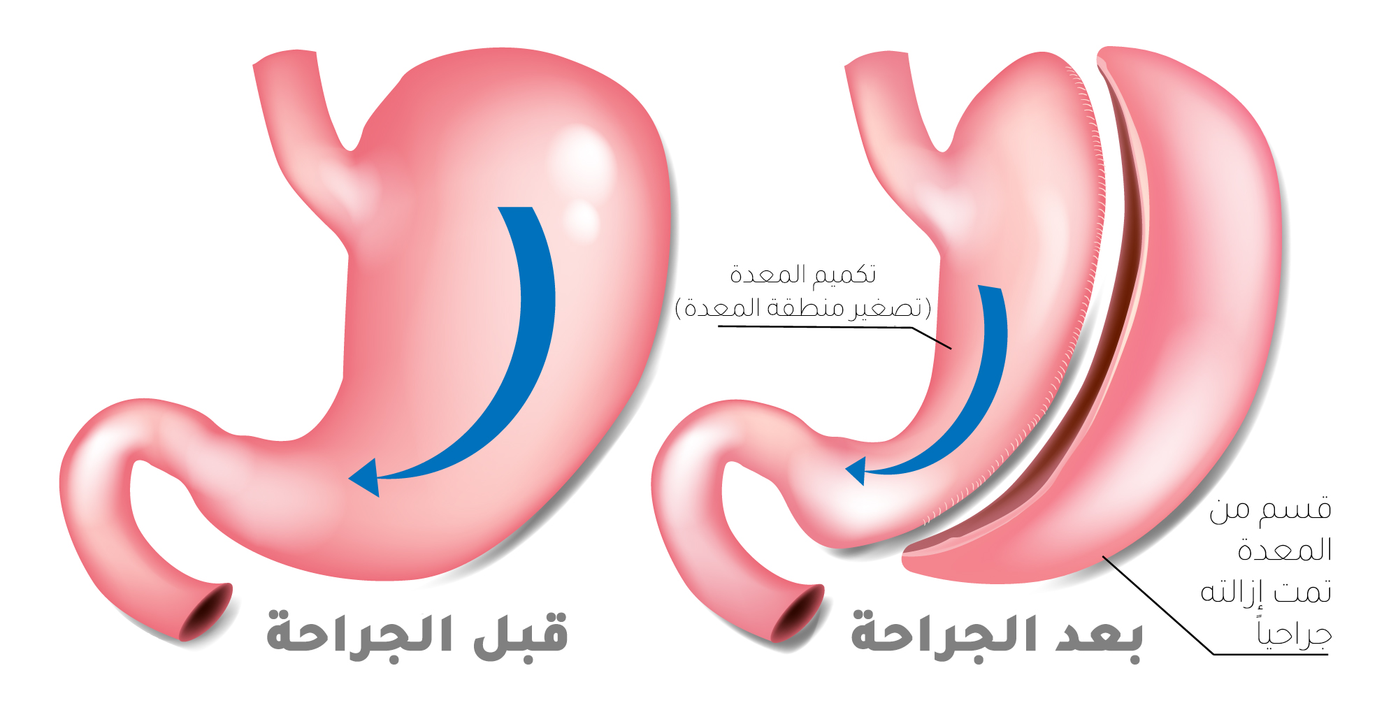 عملية تكميم المعدة