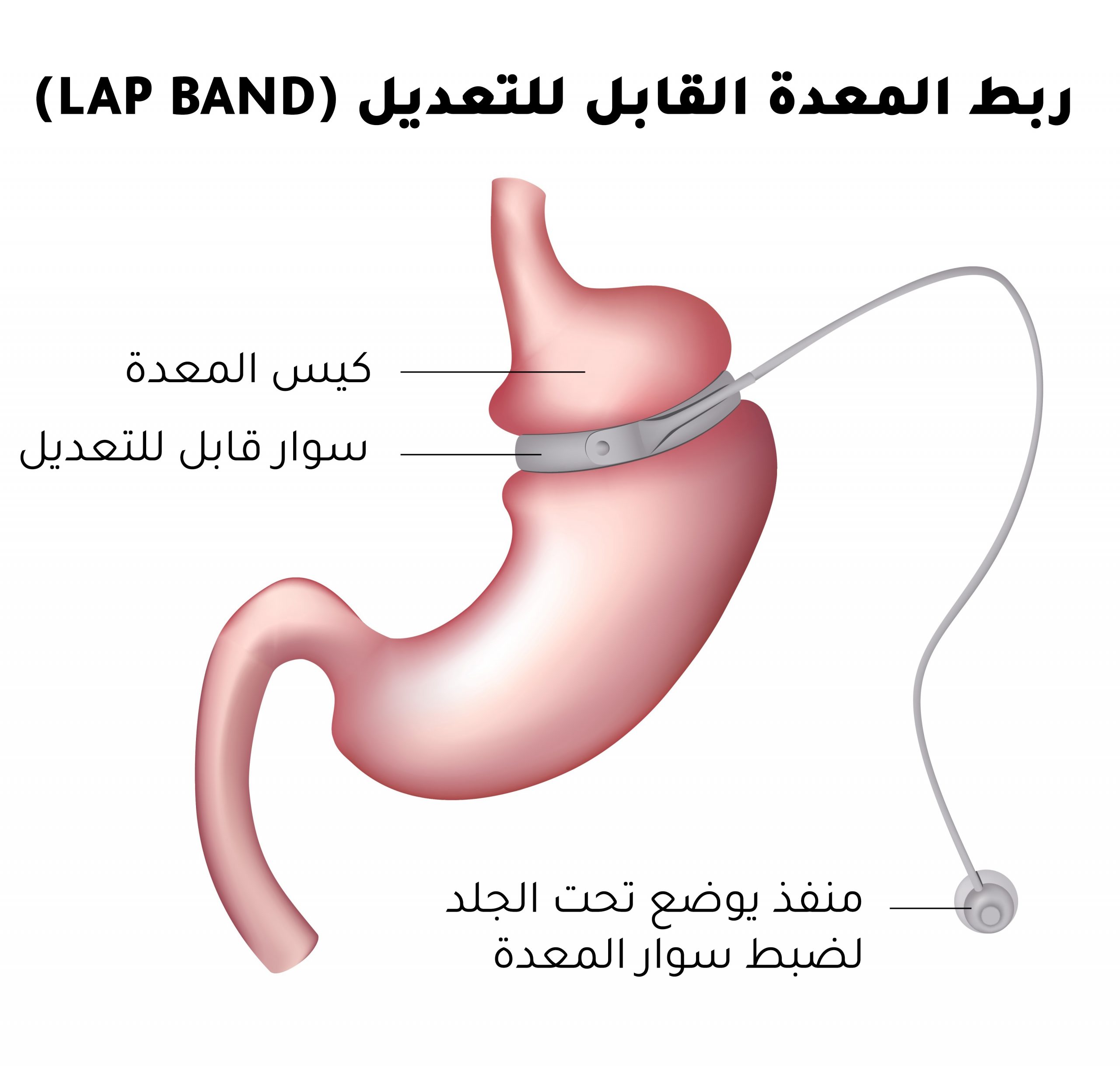 عملية ربط المعدة القابل للتعديل