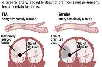 الجلطة الدماغية الخفيفة 19 الجلطة الدماغية الخفيفة