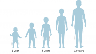تقوس الساقين