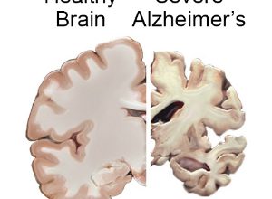 خرف الزهايمر 19 خرف الزهايمر