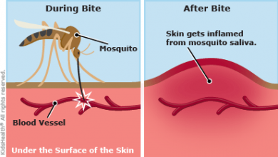 أعراض و علاج لدغة البعوض 19 لدغة البعوض