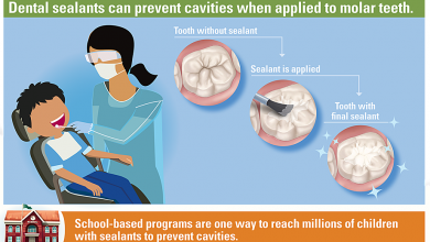 ختام سيلانت الاسنان