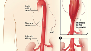 تمدد الشريان الاورطي البطني: 8 أعراض 53 تمدد الشريان الأبهري