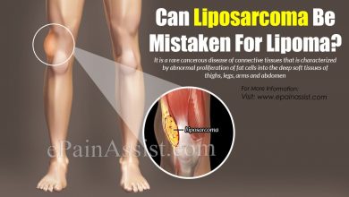 الليبوساركوما 17 الليبوساركوما