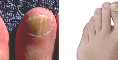 التهابات الأظافر الفطرية 20 التهابات الأظافر الفطرية