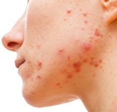 حب الشباب : 6 أسباب و 6 أنواع 21 حب الشباب : 6 أسباب و 6 أنواع