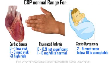 5 أمراض يكشفها تحليل CRP 22 5 أمراض يكشفها تحليل CRP , متى يكون ارتفاع CRP خطير؟