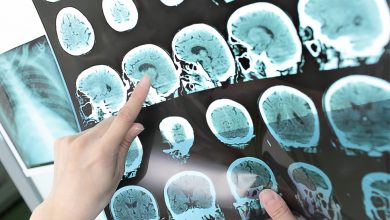 مرض التصلب العصبي المتعدد