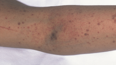 اسباب نقص الصفيحات الدموية