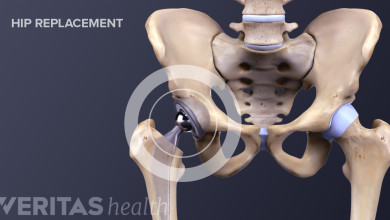 جراحة تبديل مفصل الورك 18 جراحة تبديل مفصل الورك