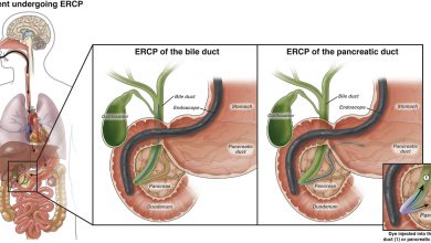 منظار ERCP البنكرياس و القناة الصفراوية 16 منظار ERCP البنكرياس و القناة الصفراوية