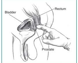 فحص وتحليل البروستاتا 18 كيف يتم فحص البروستاتا باليد؟