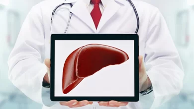 تشحم الكبد 20 تشحم الكبد , مرض الكبد الدهني