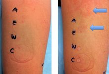 اختبار الحساسية عن طريق الجلد