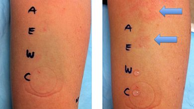 اختبار الحساسية عن طريق الجلد