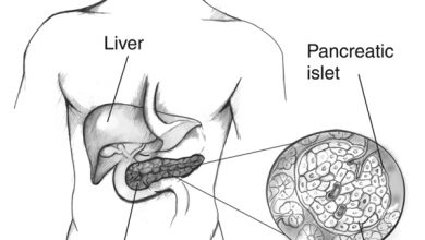 كيف اعرف اني مصاب بالسكري النوع الأول او الثاني؟