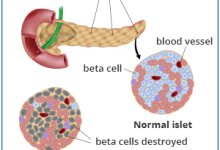 زرع خلايا البنكرياس