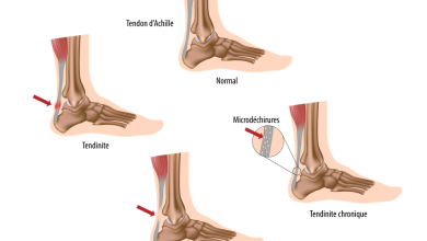 التهاب وتر العرقوب 21 التهاب وتر العرقوب أخيل أو أشيل