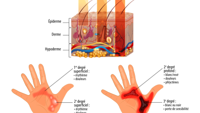درجات الحروق
