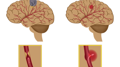 الفرق بين جلطة المخ ونزيف المخ 17 الفرق بين جلطة المخ ونزيف المخ
