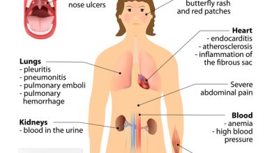 13 هي أعراض الذئبة الحمراء عند النساء 20 علامات الذئبة الحمراء عند النساء