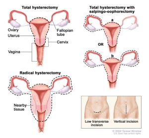 لطاخة عنق الرحم: 3 نتائج 15 حالات استئصال الرحم