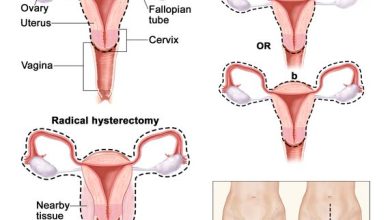 حالات استئصال الرحم