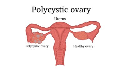 المبيض متعدد الكيسات: 7 أعراض 18 متلازمة المبيض متعدد الكيسات