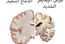 مراحل مرض داء الزهايمر