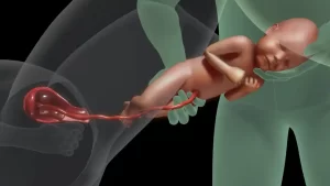 سحب الطفل خلال الولادة الطبيعية