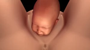 ولادة الرأس في الولادة الطبيعية