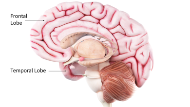 اسباب الخرف الجبهي الصدغي: 3 جينات 21 سبب الخرف الجبهي الصدغي