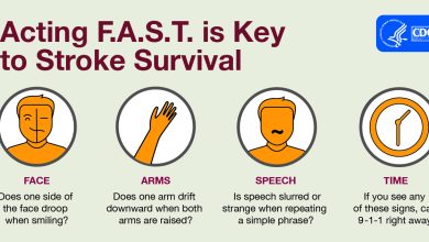 جلطة دماغية