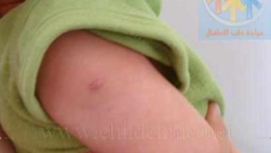 هل تطعيم الدرن ضروري؟ 5 حالات 20 تطعيم الدرن او لقاح السل