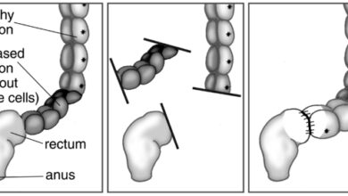 ضخامة القولون الولادية مع غياب الاعصاب