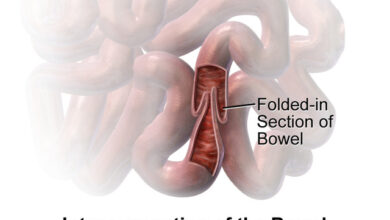 أسباب انغلاف الأمعاء عند الرضع