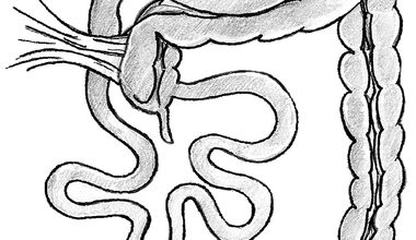 سوء دوران الأمعاء عند الطفل