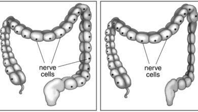 داء هيرشسبرينج