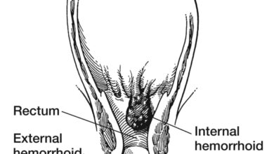 البواسير: 5 أعراض 14 اعراض وعلامات البواسير