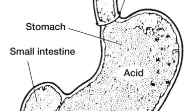 ارتجاع الحمض المعدي عند الرضع: 7 أسباب 19 ارتجاع الحمض المعدي إلى المري عند الرضع