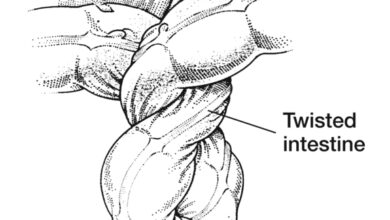 التفاف الأمعاء: 4 أسباب 15 التفاف والتواء الأمعاء