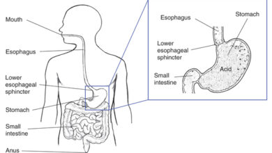 مريء باريت: 6 أعراض 1