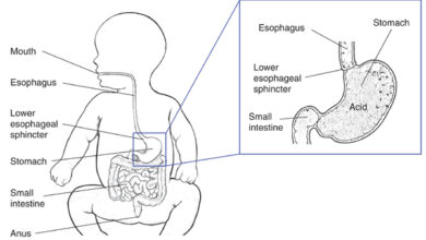 ارتجاع والتهاب المريء عند الرضع