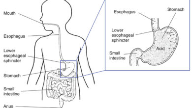 الترجيع المستمر مع الحموضة عند الأطفال: 7 أسباب 20 الترجيع المستمر مع حموضة عند الأطفال