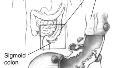اسباب جيوب ورتوج القولون