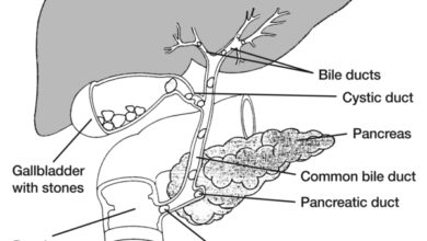 اسباب حصوات المرارة