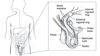 الفتق الاربي: 3 أعراض 18 اعراض الفتق الاربي