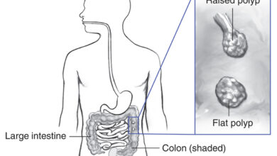 اعراض بوليبات القولون
